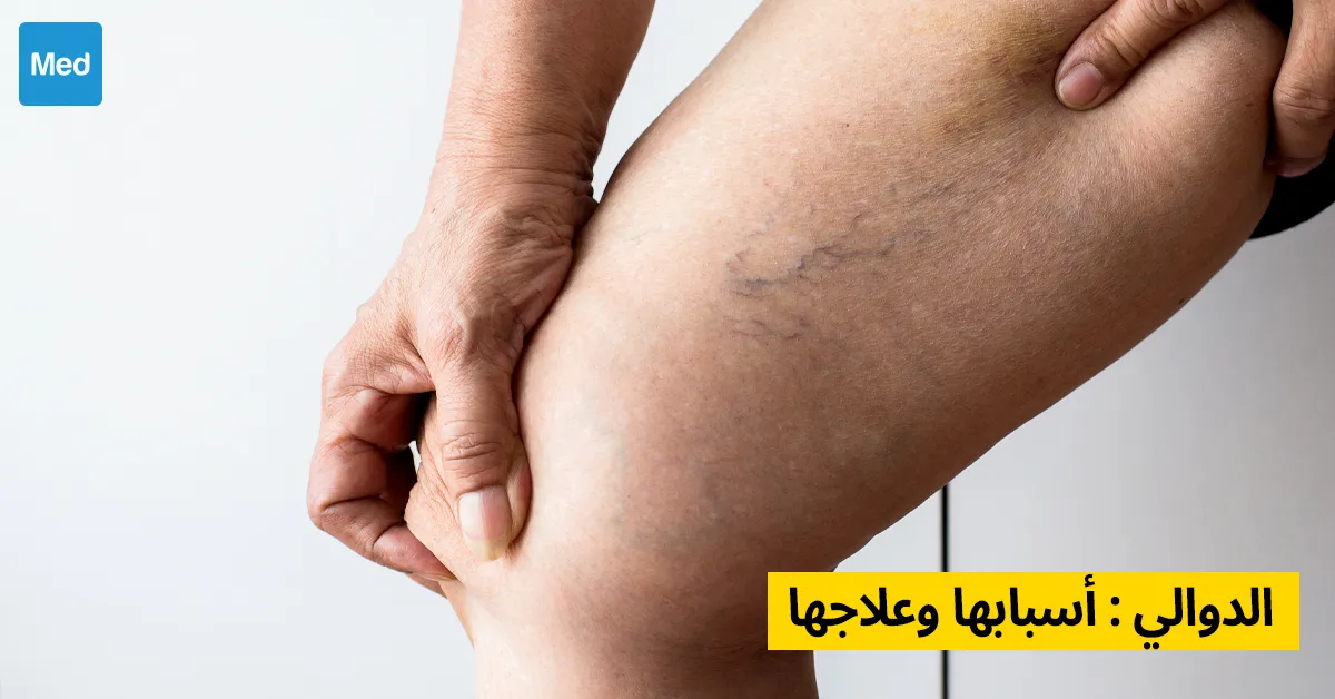 الدوالي : أسبابها وعلاجها